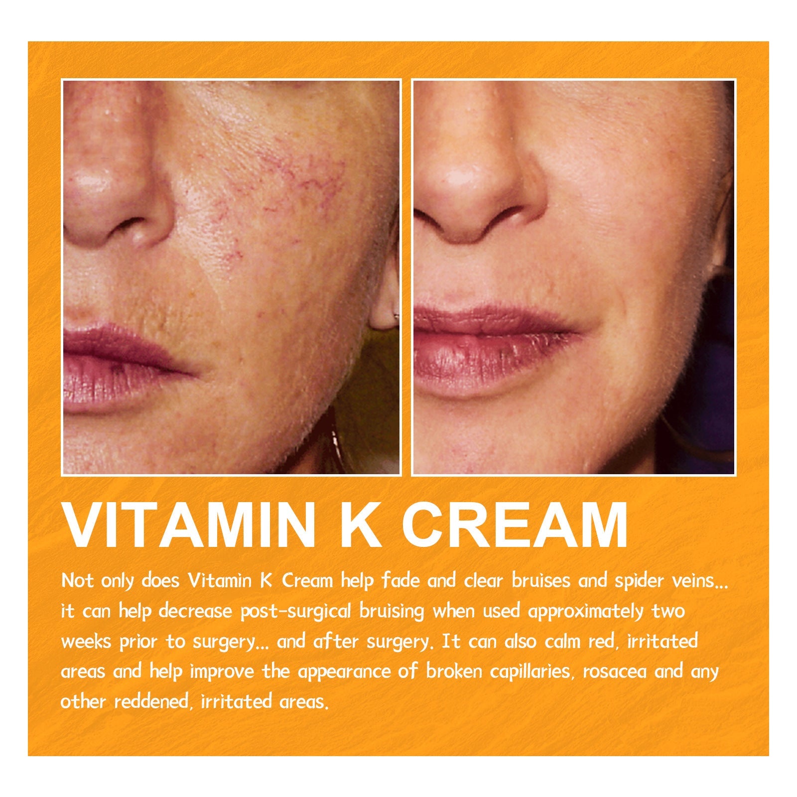 EELHOE Bulge & Swelling Of Legs Repair Cream EELHOE COSMETICS