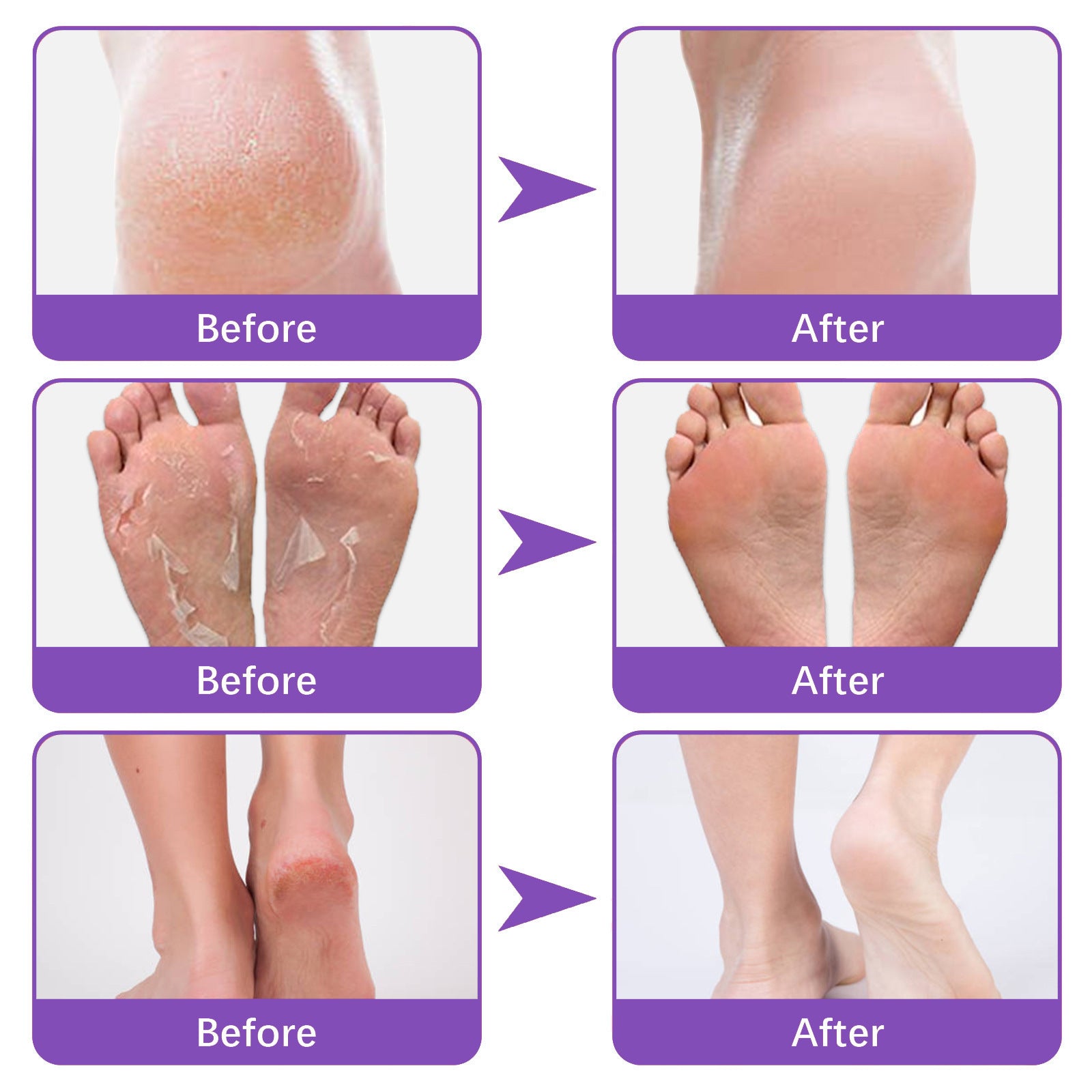 EELHOE Mask Foot Skin Chapped Exfoliating Skin Moisturizing And Nourishing Foot EELHOE COSMETICS