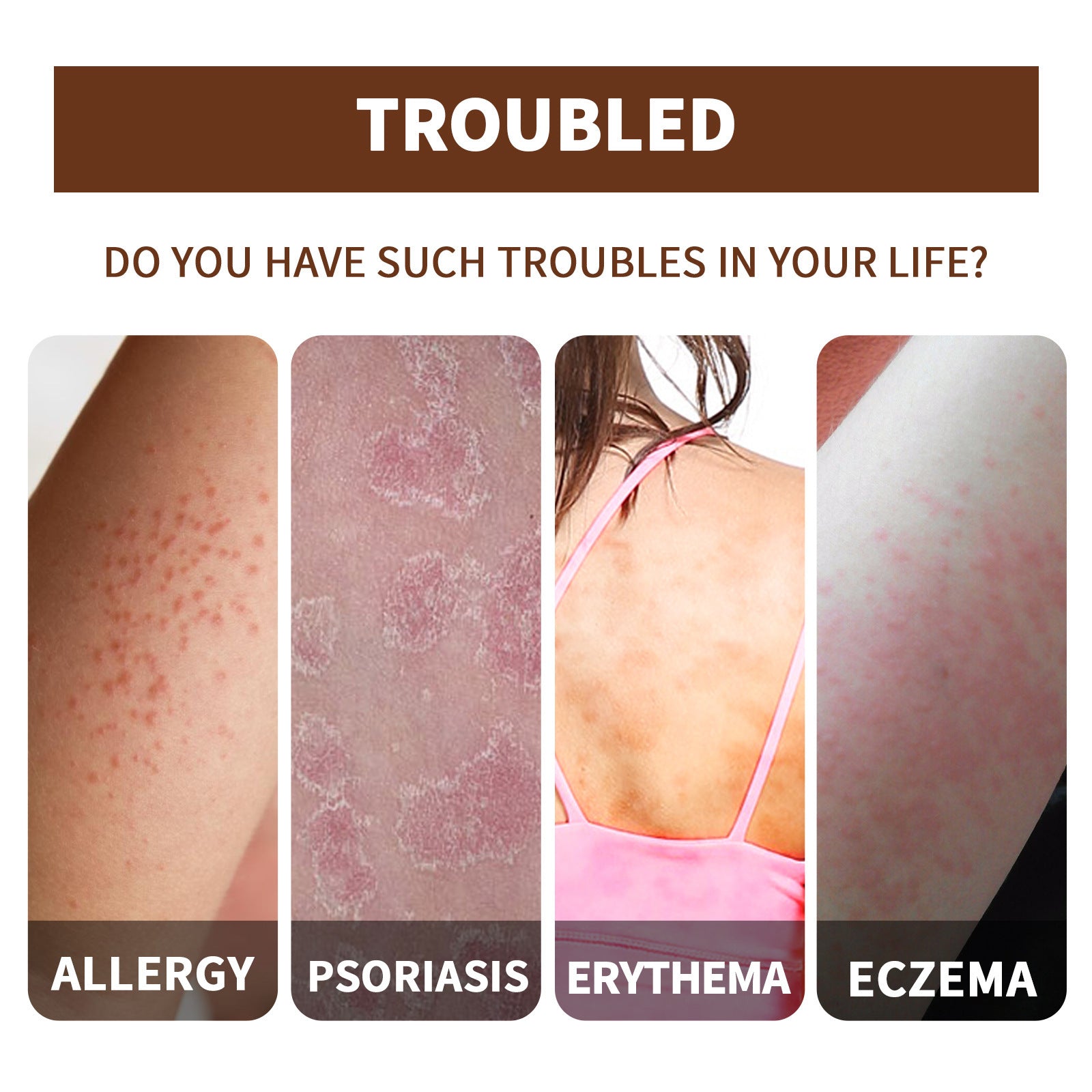 EELHOE Exczema and Psoriasis Cure Skin Moss Repair Essential Oil Relieves Itching EELHOE COSMETICS