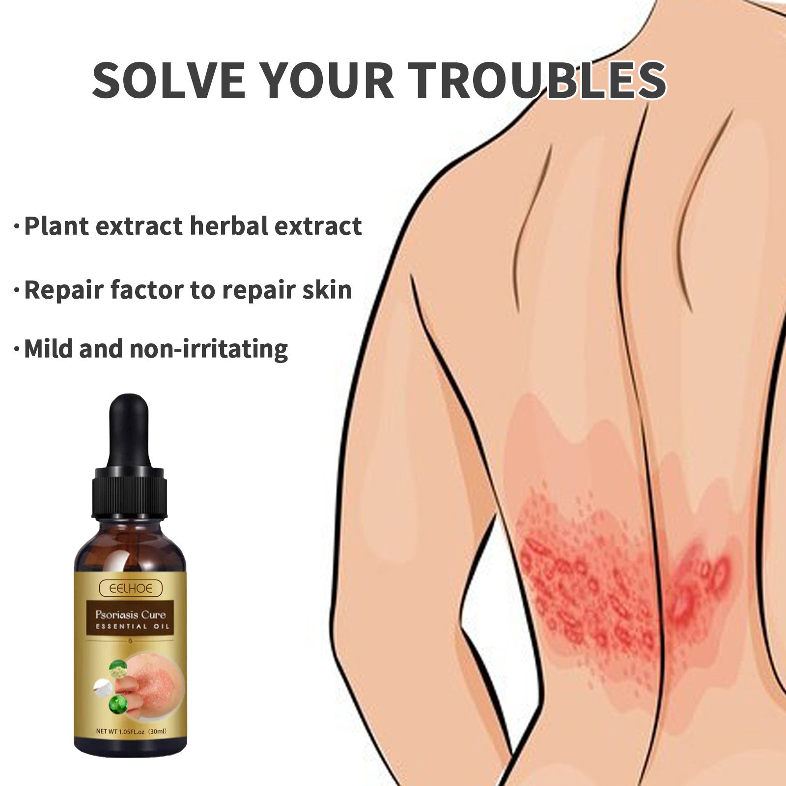 EELHOE Exczema and Psoriasis Cure Skin Moss Repair Essential Oil Relieves Itching EELHOE COSMETICS