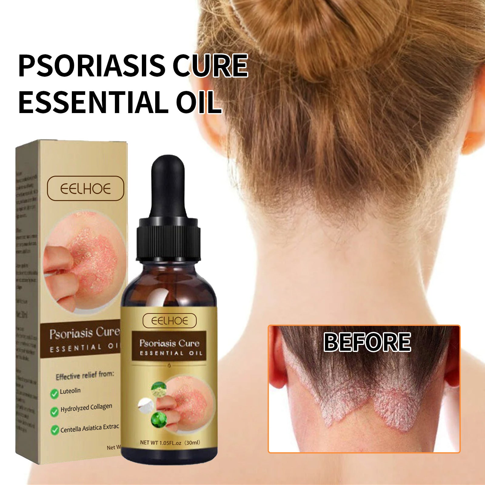 EELHOE Psoriasis Cure Skin Moss Repair Essential Oil Relieves Itching