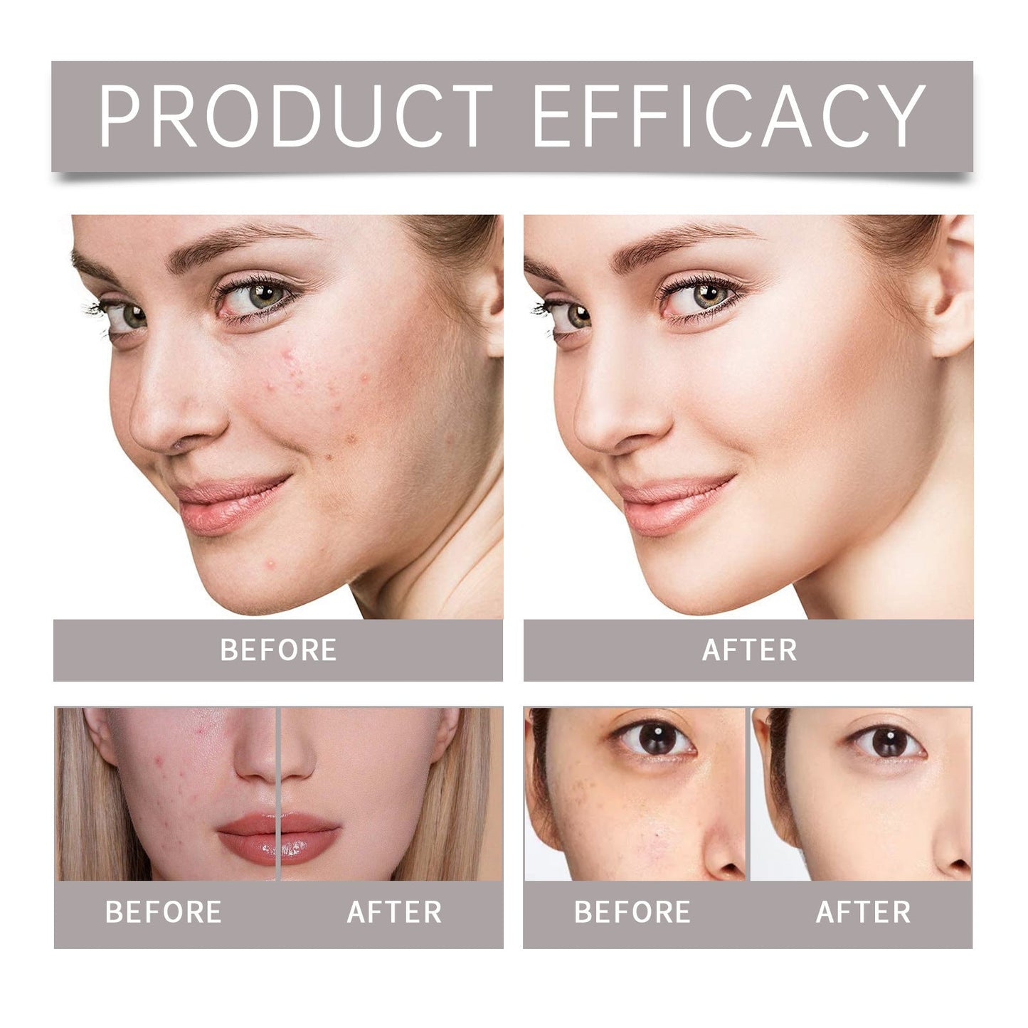 Eelhoe Anti-Acne Care Set - Brightens Skin and Moisturizes EELHOE COSMETICS