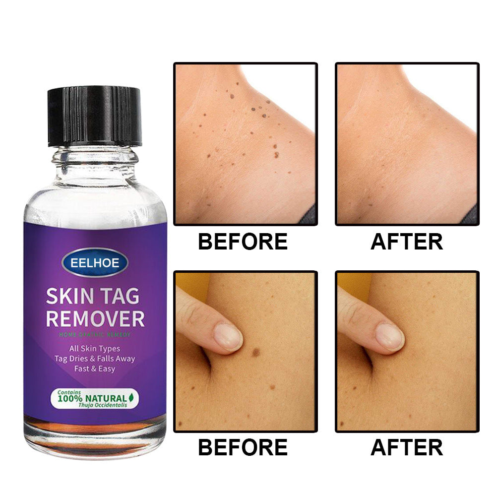 Eelhoe Skin Tag Remover To Solve Skin Verrucous