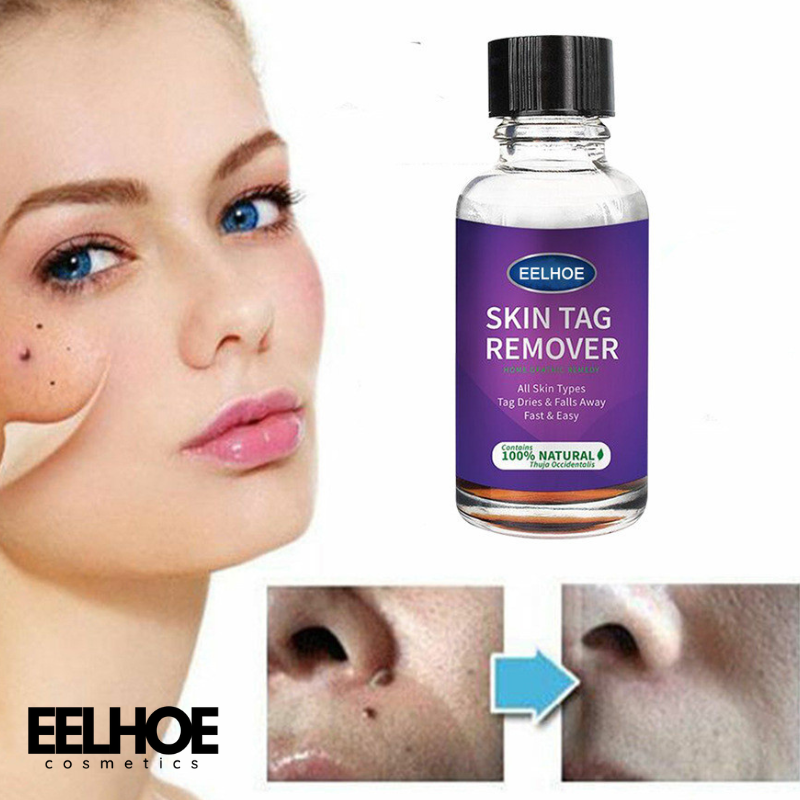 Eelhoe Skin Tag Remover To Solve Skin Verrucous