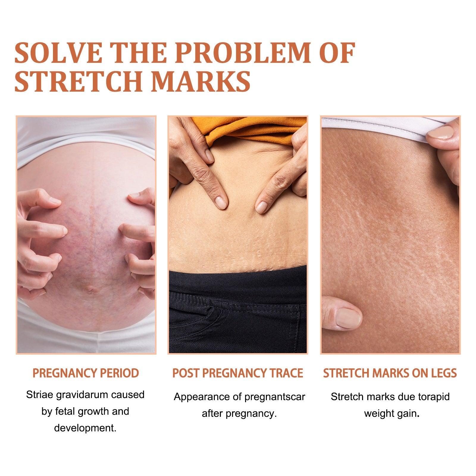 Anti-Stretch Mark Essential oil Repair for Postpartum Obesity Growth Fade Fat