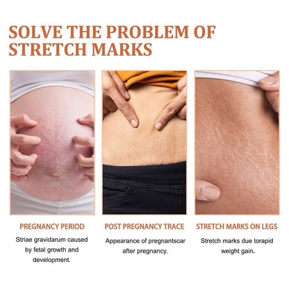EELHOE Anti Stretch Mark oil for Postpartum and Obesity EELHOE COSMETICS