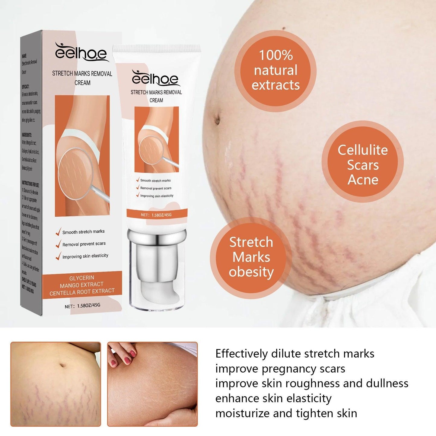 EELHOE Anti Stretch Mark oil for Postpartum and Obesity EELHOE COSMETICS